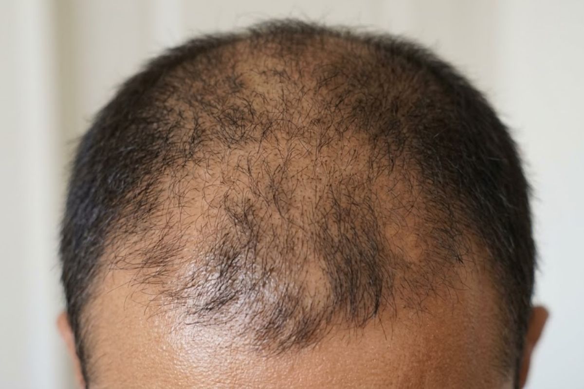 Before treatment